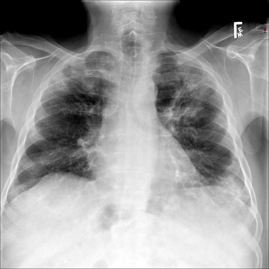 Lung x-ray showing acute eosinophilic pneumonia